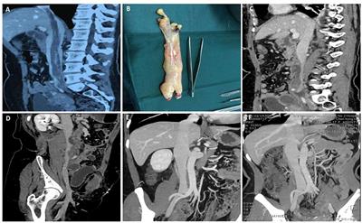 Surgery Treatment of Primary Tumors of the Inferior Vena Cava